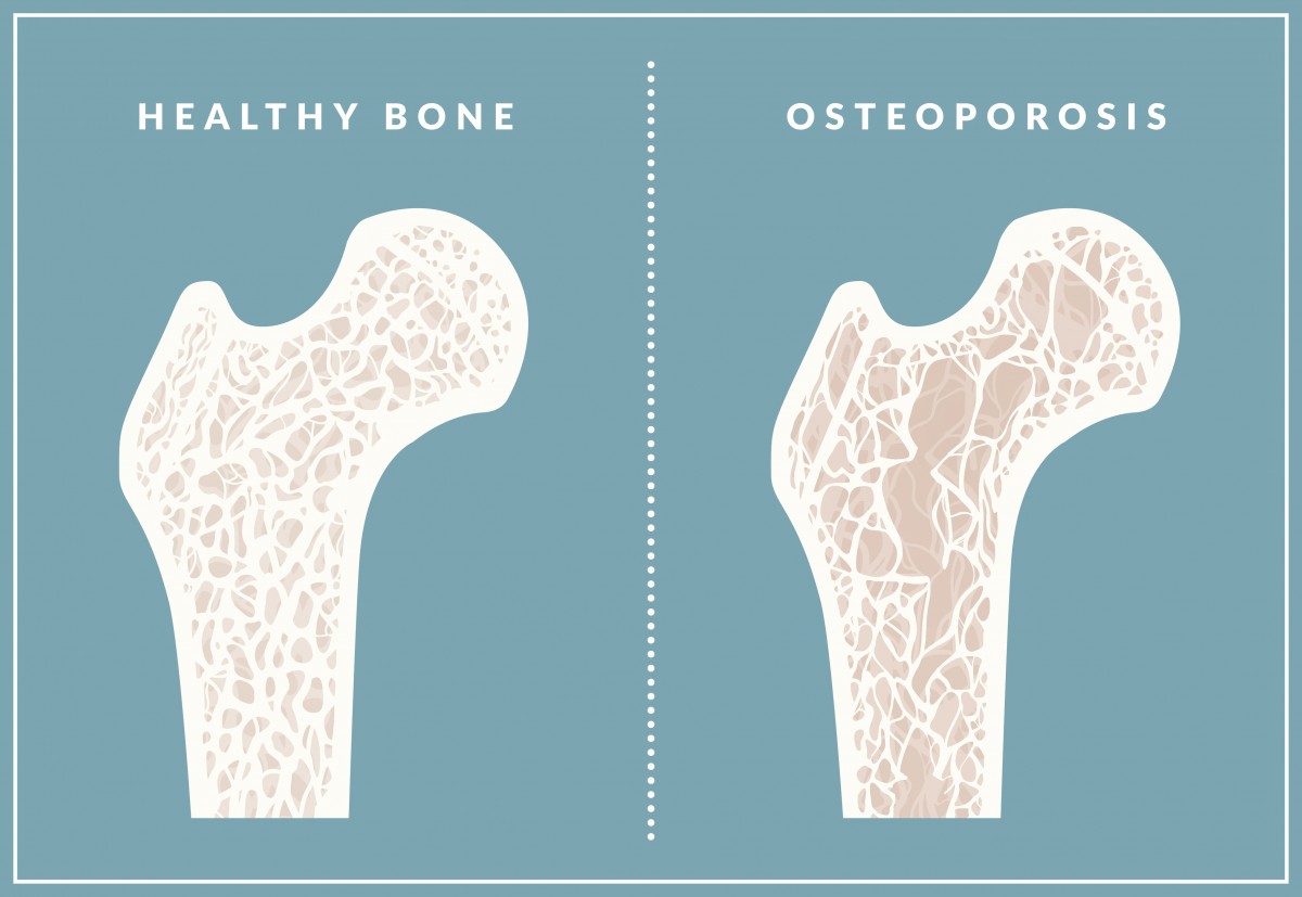 Healthy bone, left, resembles a web or honeycomb. With osteoporosis, the bone weakens and spaces develop, which increases the risk of fractures.