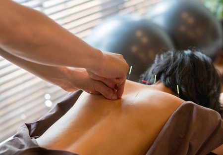 CROPPEDTWOAcupuncture-woman-back_iStock_542827942